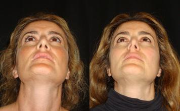 операция на перегородку носа
