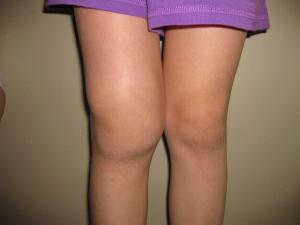 коленный сустав артроз