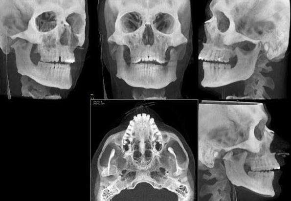 компьютерная томография челюсти снимок зубов 3d