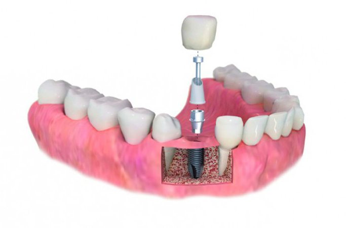 одномоментная имплантация зубов как происходит