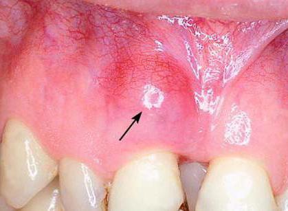 нарыв на десне причины и лечение
