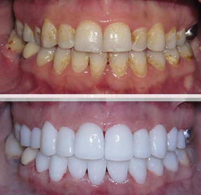 современные методы чистки зубов у стоматолога 