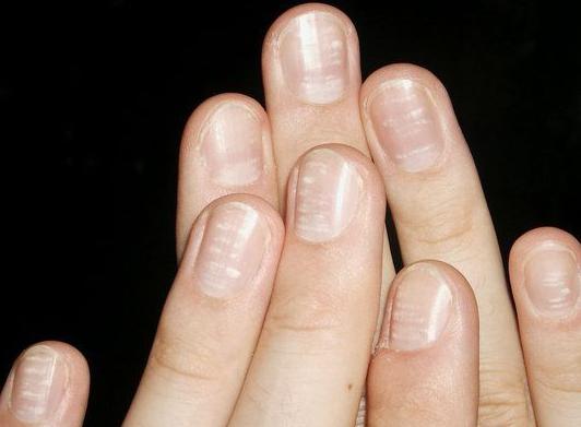 Ребристые ногти на руках: причины и лечение