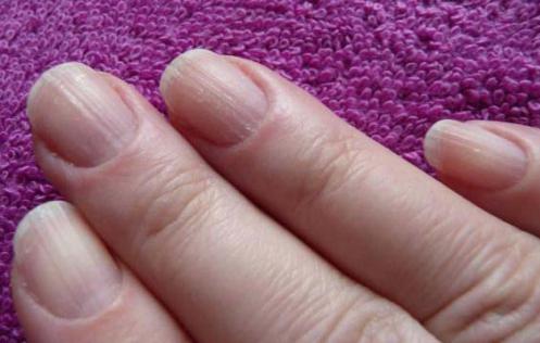 Ребристые ногти на руках: причины и лечение