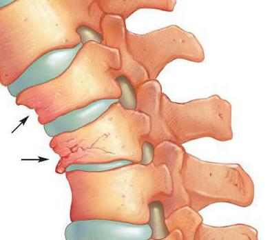 остеопороз позвоночника симптомы и лечение народными средствами