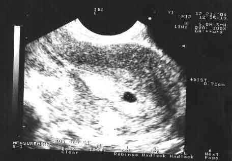 пятая эмбриональная неделя беременности что происходит 