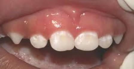  ранний кариес молочных зубов 