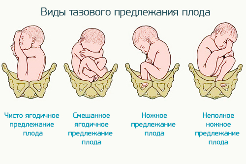 типы тазовых предлежаний эмбриона