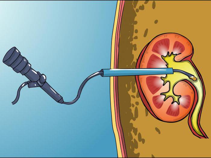 камни в мочеточнике у мужчин операция