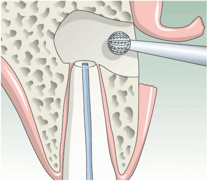 цистэктомия зуба
