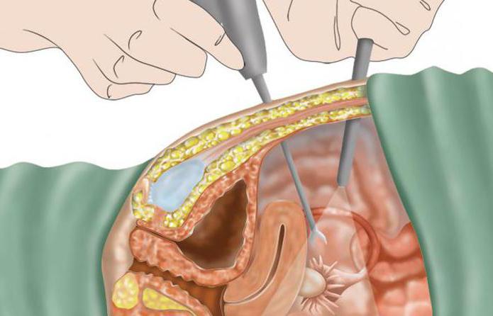 поликистоз яичников после лапароскопии отзывы