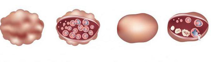 лапароскопия при поликистозе яичников и беременность отзывы