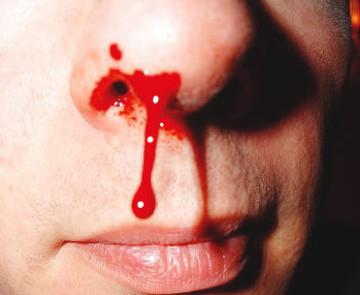 кровь из носа последствия