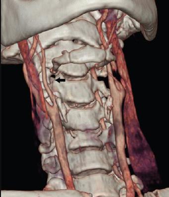 остеохондроз шейно-грудного отдела позвоночника