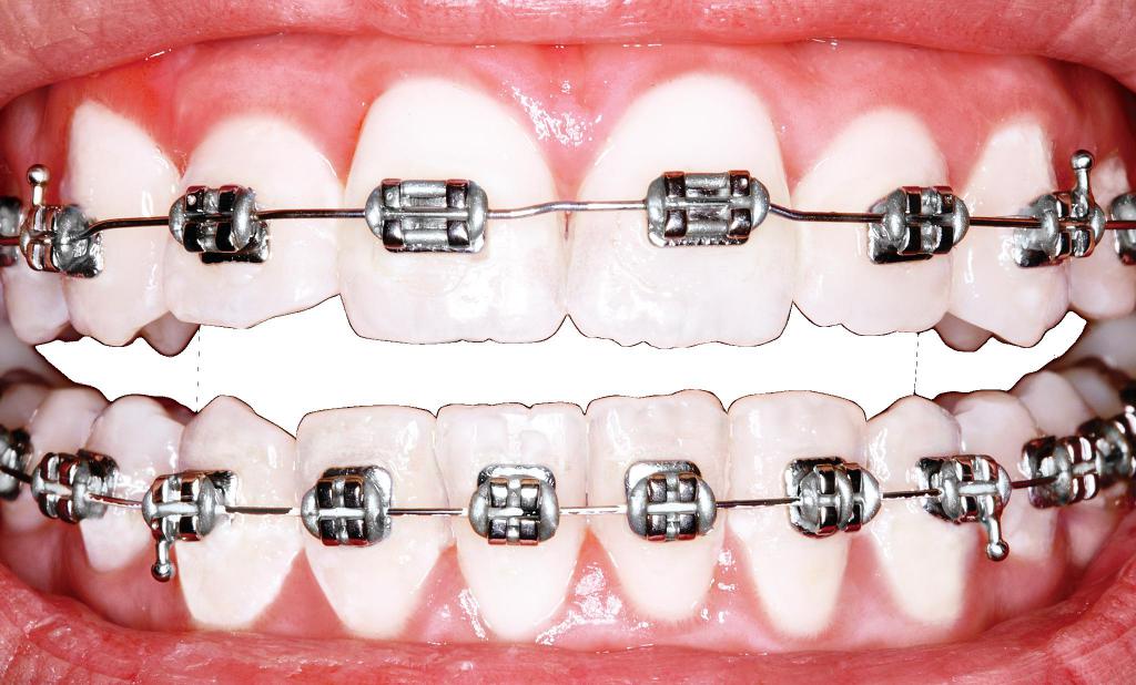 выравнивание зубов
