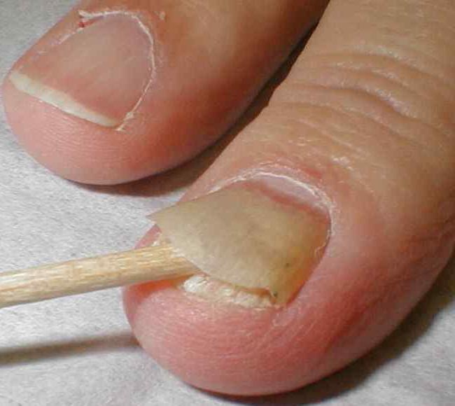Как определить грибок ногтей на ногах: симптомы, возможные причины и особенности лечения