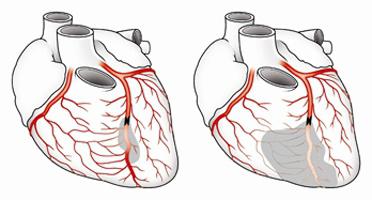 коронарография сосудов сердца осложнения