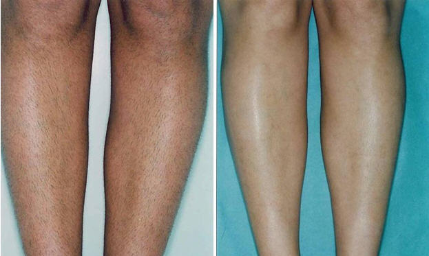 Лазерная эпиляция голеней: технология процедуры, описание, противопоказания, фото до и после