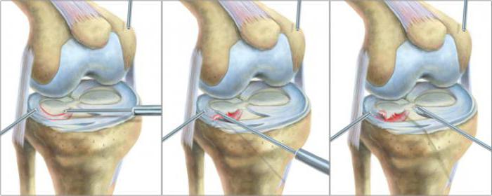 мениск коленного сустава лечение операция