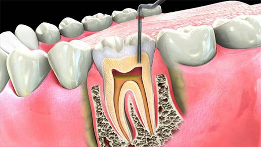 эндодонтическое лечение зубов