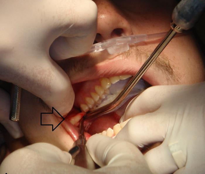 удаление зуба мудрости на верхней челюсти последствия 
