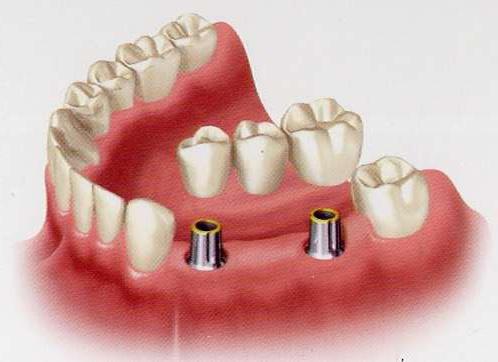 какие зубные протезы лучше поставить если вообще нет зубов