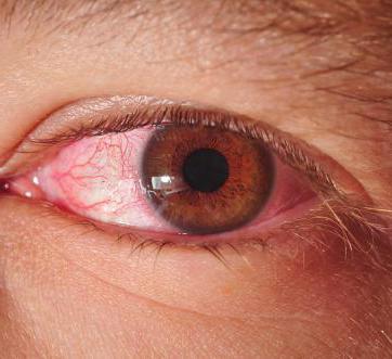  заболевание глаз эписклерит 