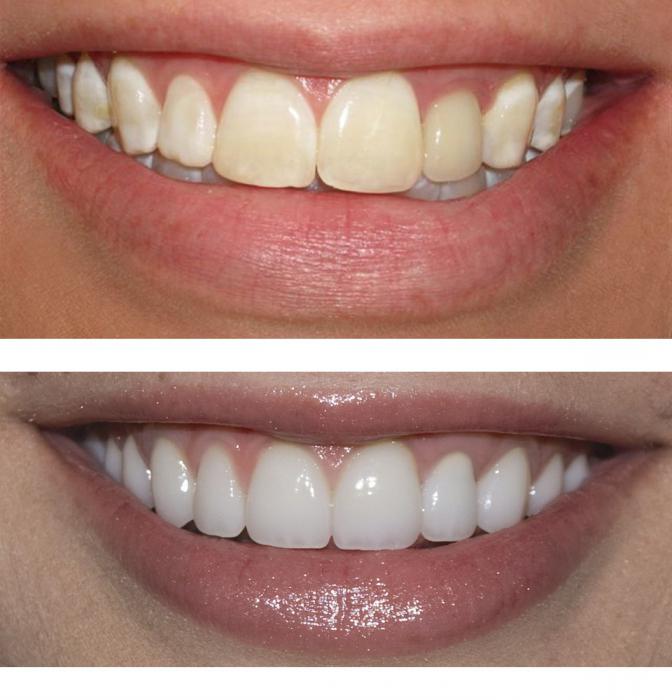 Реставрация зубов: до и после. Художественная реставрация зубов