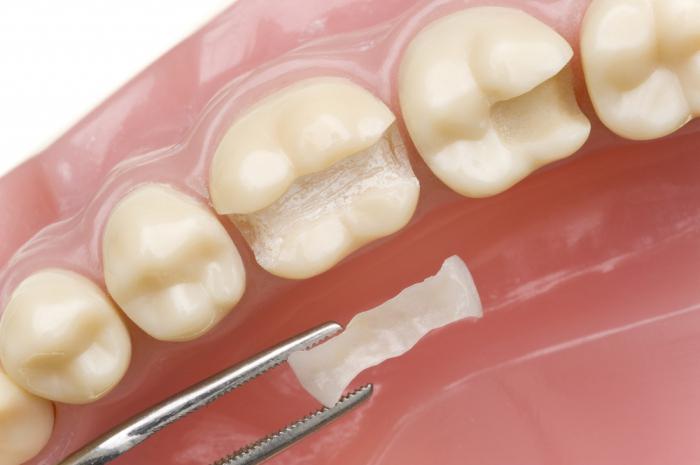 реставрация зубов отзывы