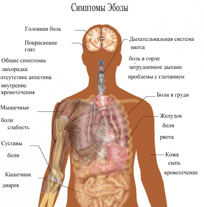 лихорадка эбола симптомы