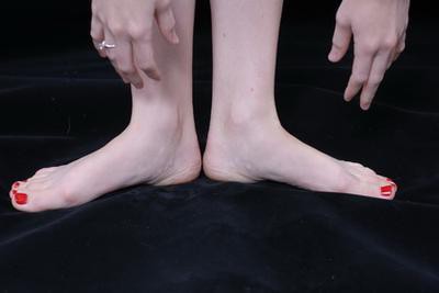 онемение ног и рук причины 