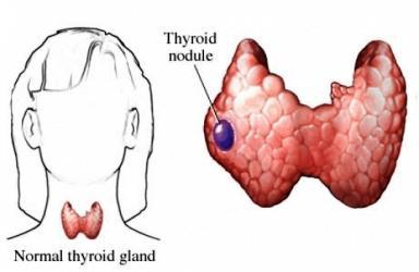 токсическая аденома щитовидной железы симптомы
