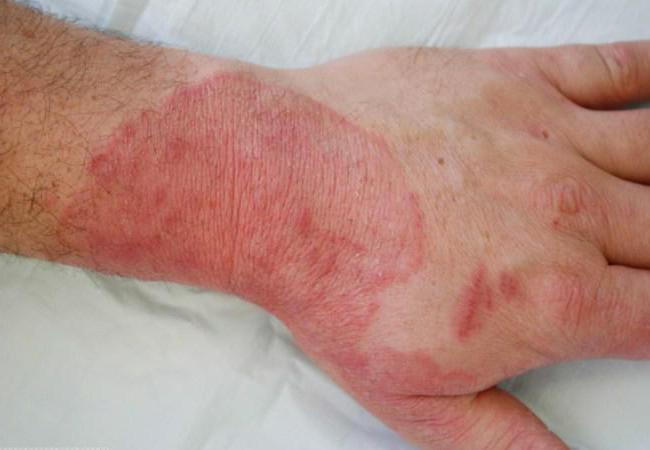 микозы кожи лечение