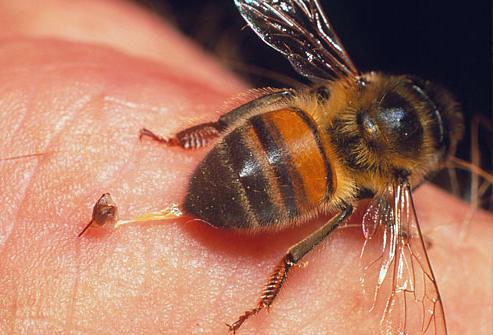лечение варикоза пчелами