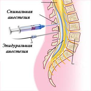 анестезия спинномозговая это