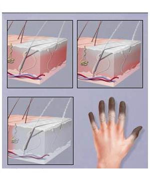 обморожение пальцев рук лечение
