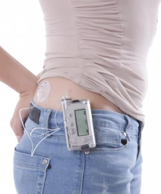 инсулиновая помпа от диабета отзывы