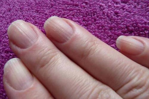 Неровные ногти на руках: причина, лечение