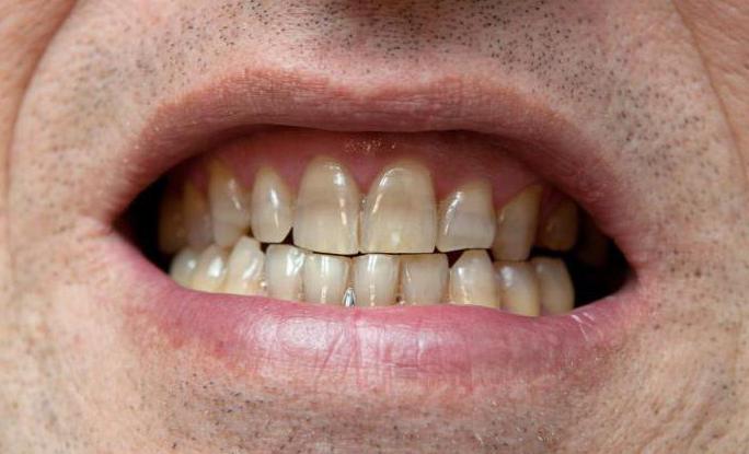 отбеливание тетрациклиновых зубов до и после