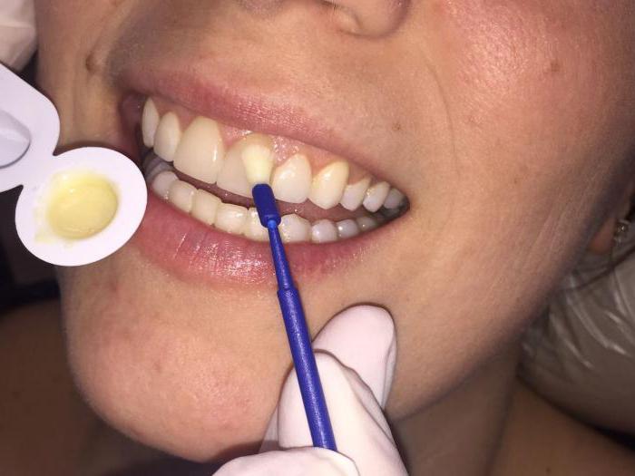 отбеливание тетрациклиновых зубов отзывы 