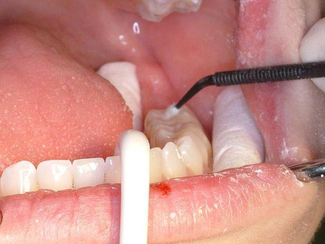углубления жевательной поверхности зуба