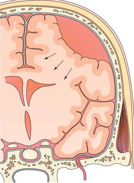 субдуральное кровоизлияние