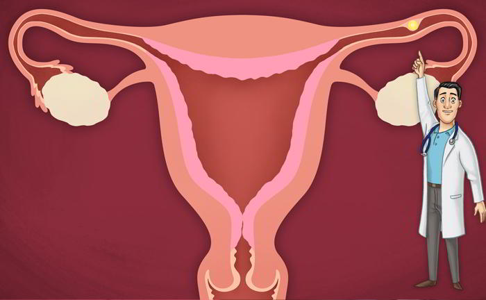 трубная внематочная беременность