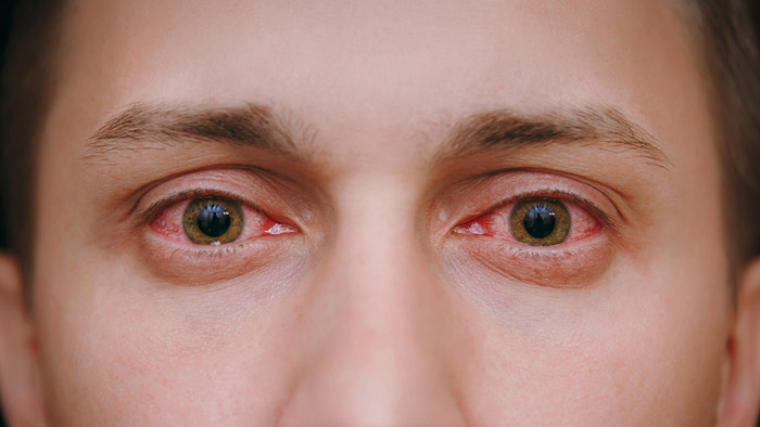 симптомы трахомы глаз