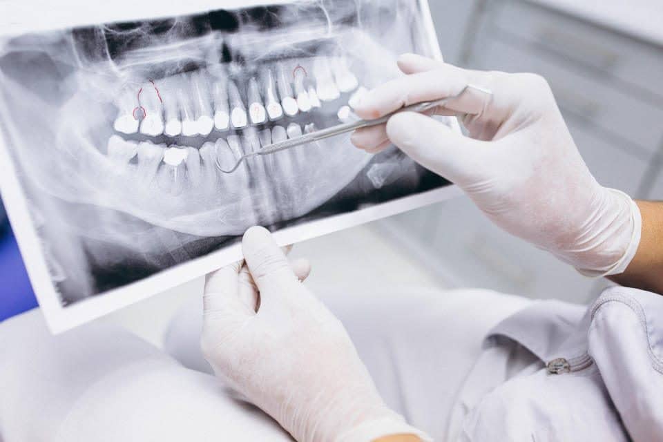 Удаляют ли зуб при флюсе: особенности ситуации