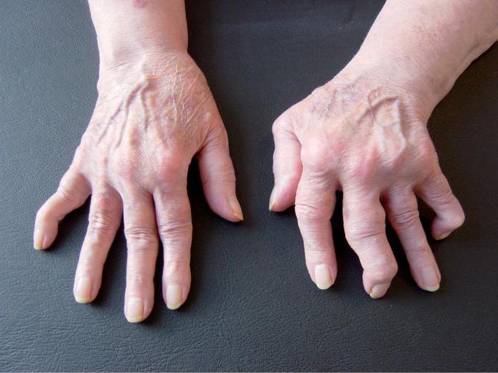 первые симптомы ревматоидного артрита пальцев рук