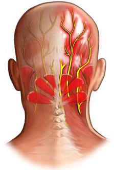 Невралгия затылочного нерва симптомы лечение