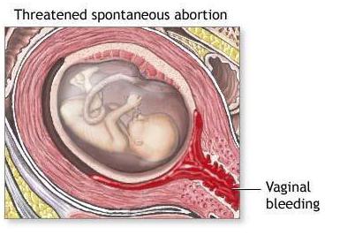 угрожающий аборт