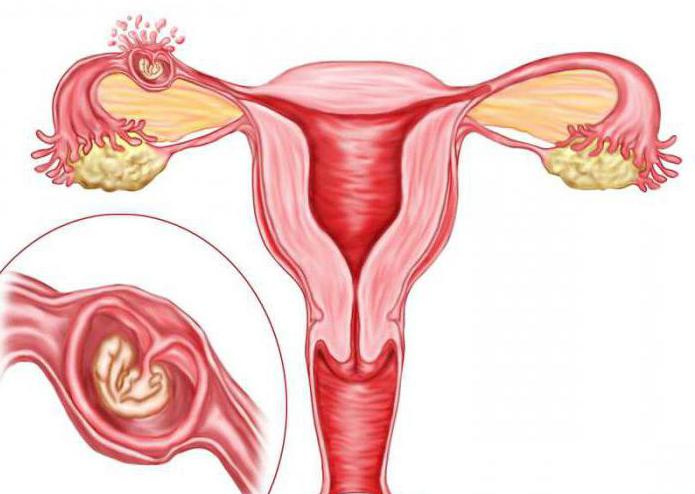 внематочная беременность трубный аборт