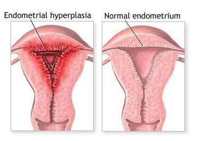 выскабливание при гиперплазии эндометрия